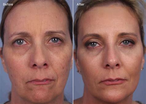 Glycolic Acid Peels: Benefits, Efficacy, Side Effects & Cost.